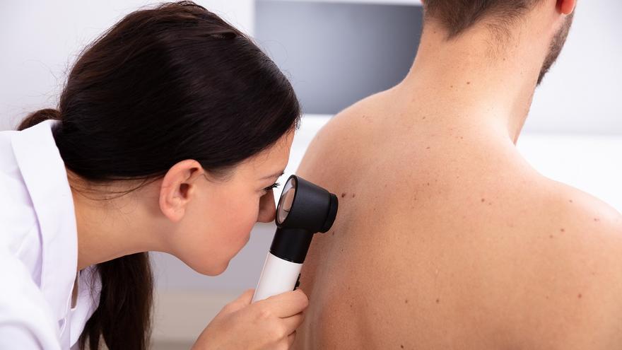 Do you know the ABCDE rule to detect this skin cancer early?