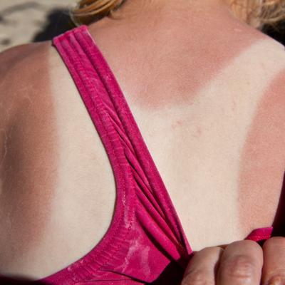 Skin cancer can show up in unexpected places