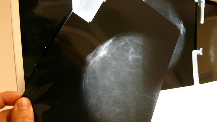 Study questions dogma about how most breast cancers arise