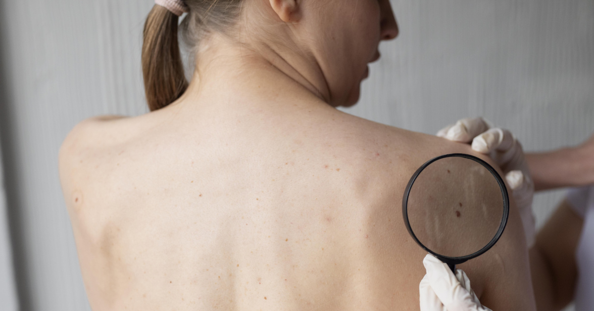 What is Mohs surgery, the new technique to remove skin cancer