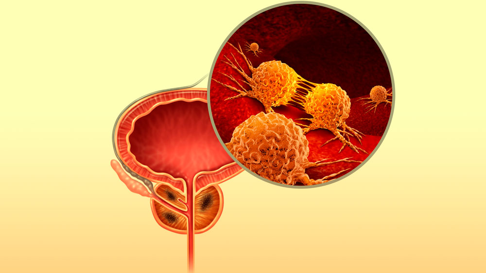 Prostate Cancer: Increase in cases anticipated - Articles