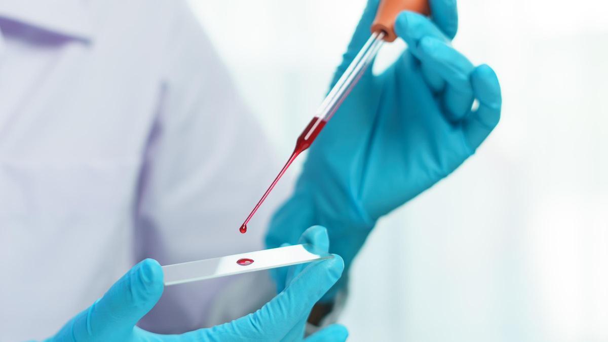 A blood test can predict future relapses in breast cancer patients