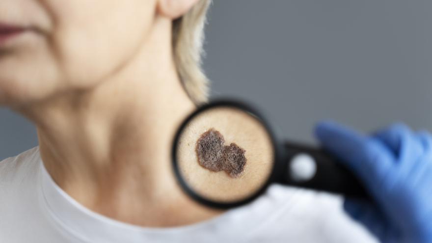 SKIN CANCER ALICANTE |  Eight out of ten melanomas can be cured with early diagnosis