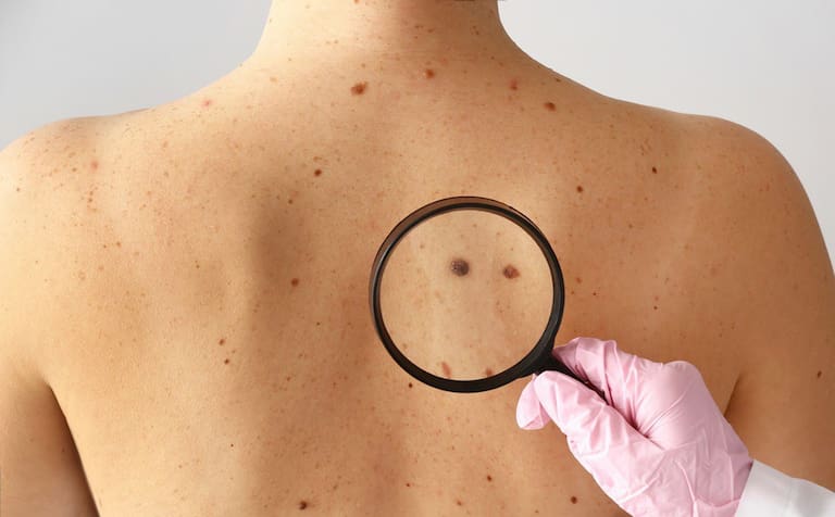 The treatment for skin cancer that has the highest cure rate and few places perform