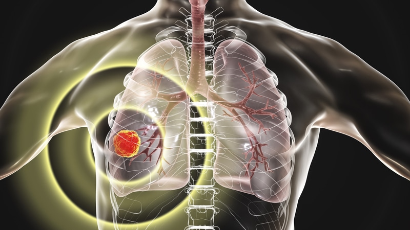 How has clinical research into lung cancer evolved in Latin America?