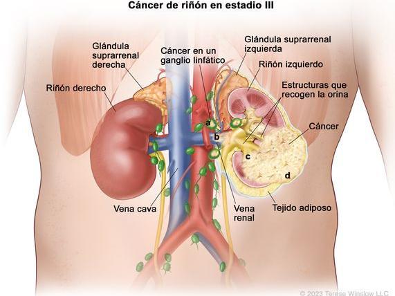 Adjuvant use of Keytruda improves kidney cancer survival