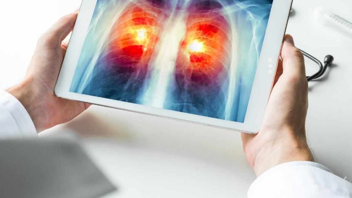 LUNG CANCER SCREENING | Doctors call for a boost for lung cancer screening nationwide